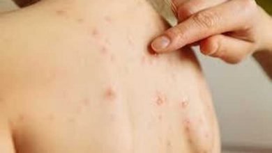 Badan Kesehatan Inggris: Cacar Monyet Menginfeksi Gay dan Biseks