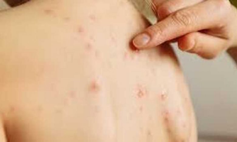 Badan Kesehatan Inggris: Cacar Monyet Menginfeksi Gay dan Biseks