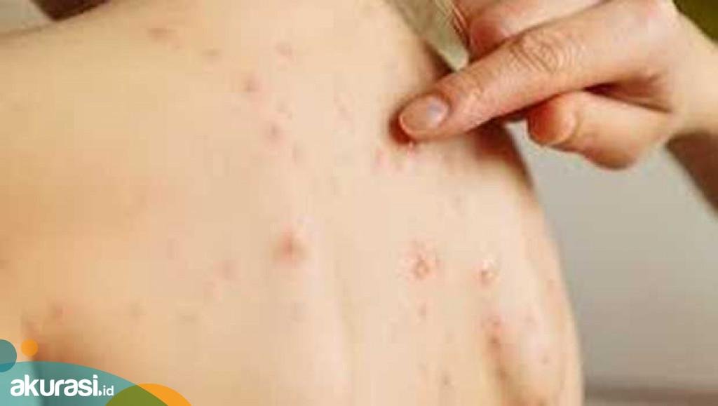 Badan Kesehatan Inggris: Cacar Monyet Menginfeksi Gay dan Biseks