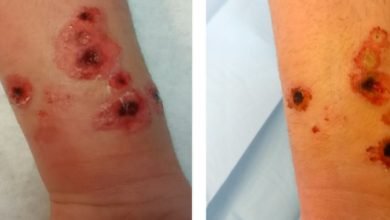 Anthrax di Indonesia: Memahami Implikasinya dan Mengambil Tindakan