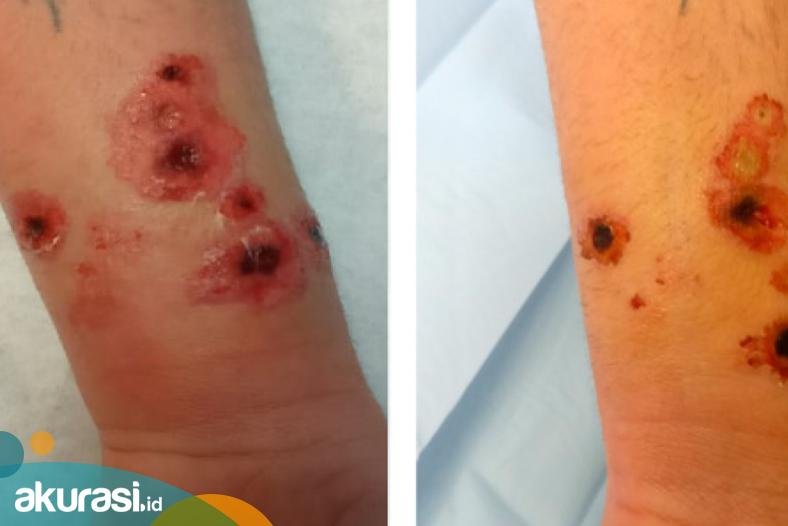 Anthrax di Indonesia: Memahami Implikasinya dan Mengambil Tindakan