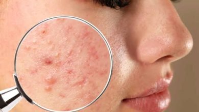 Mengenal Bentuk Jerawat dan Penyebabnya, Ada Apa Saja