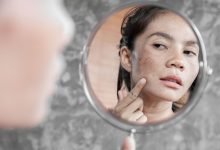 Inilah Penyebab dan Cara Atasi Flek Hitam di Wajah