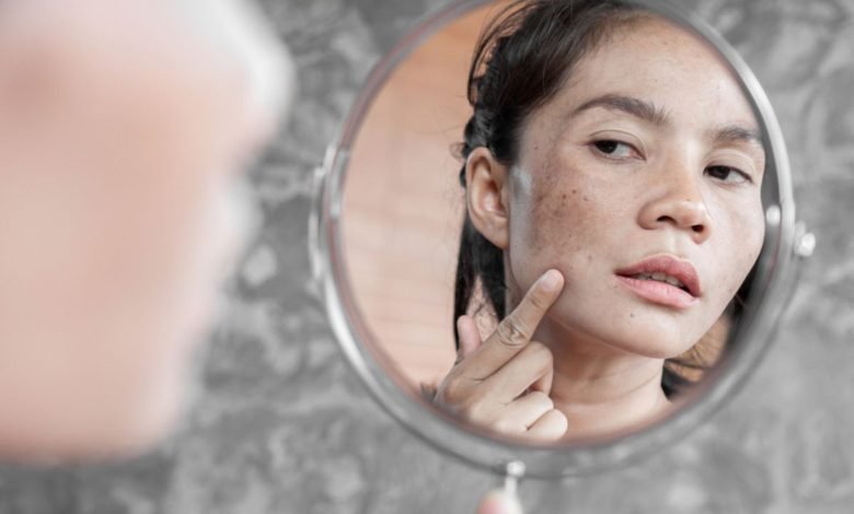Inilah Penyebab dan Cara Atasi Flek Hitam di Wajah