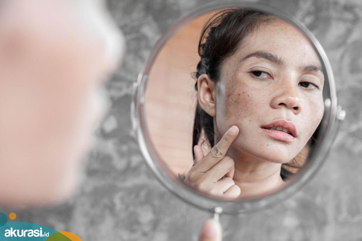 Inilah Penyebab dan Cara Atasi Flek Hitam di Wajah
