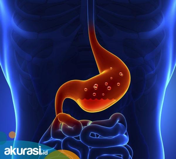 Mengenal Apa Itu GERD, Berikut Penyebab dan Cara Mengobatinya